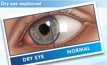 Dry Eye & Computer Vision Syndrome Class